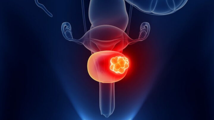 Cancro na bexiga